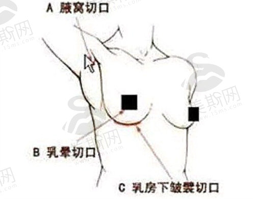 隆胸手术腋窝切口