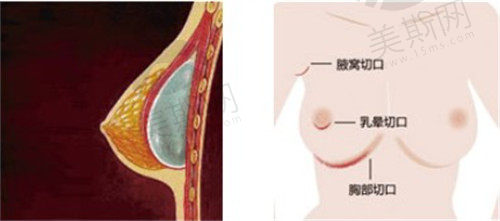 乳晕切口