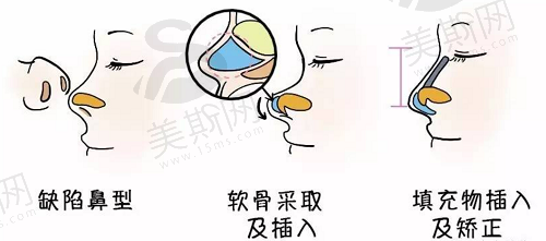 宁波薇琳整形医院做鼻子好吗