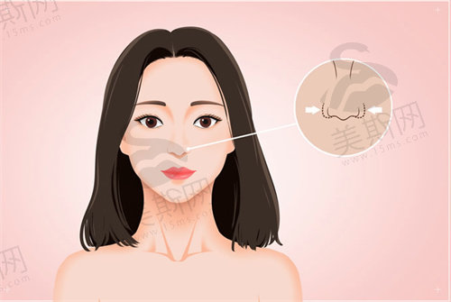 宁波薇琳阮凯膨体肋骨鼻综合有哪些优势