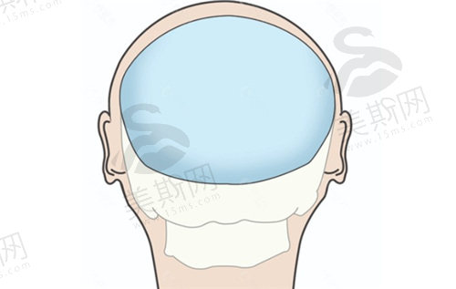 韩国雕刻整形医院做骨水泥填充后脑勺手术的优势