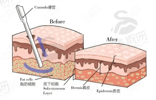 韩国365mc吸脂医院的兰斯吸脂手术口碑不错