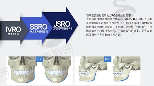 韩国菲斯莱茵整形医院可以把整个脸的面积缩小吗