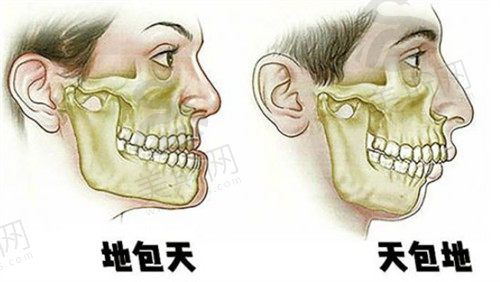 双鄂手术可纠正咬合