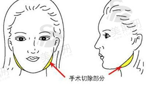 韩国梦想整形外科医院面部轮廓整形价格表