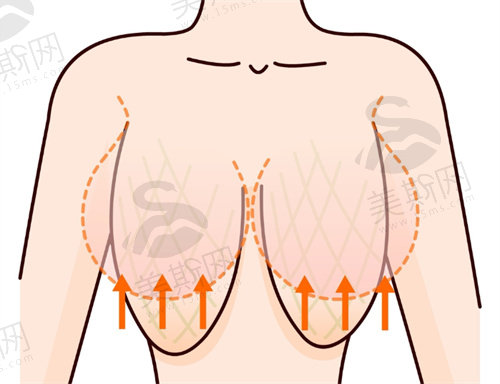 郑州巨乳缩小手术哪个医生好？