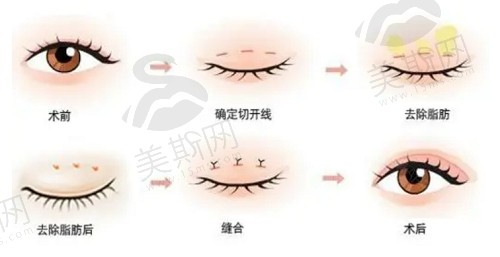 宁波整形外科医院叶巍明眸大眼术有哪些优势