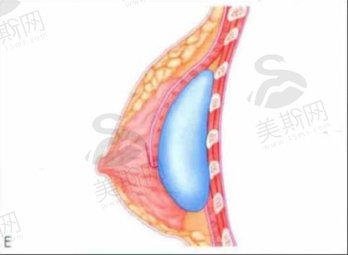 韩国UcanB整形医院隆胸手术优势