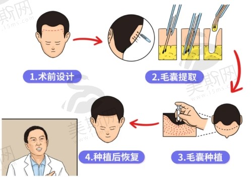 金承俊医生的无痕毛发移植技术口碑好