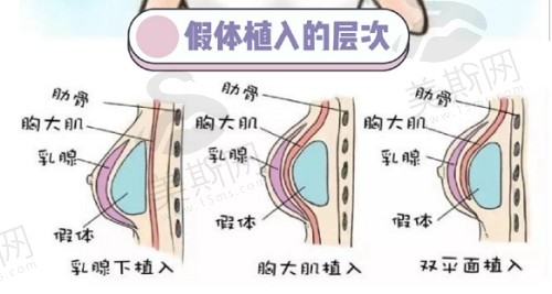 韩国md整形医院李相达院长做胸有哪些优势