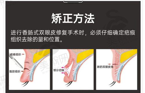 哪种情况需要做肉条眼修复