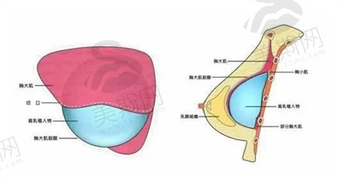 北京煤医西坝河整形王驰医生做假体隆胸技术成熟