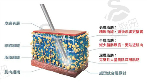 李光琴医生自体脂肪技术不错