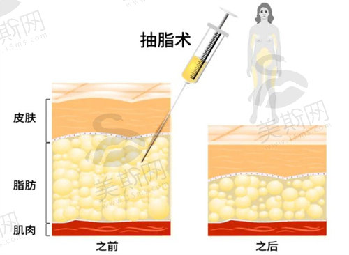 昆明杰西艾美容医院吸脂价格