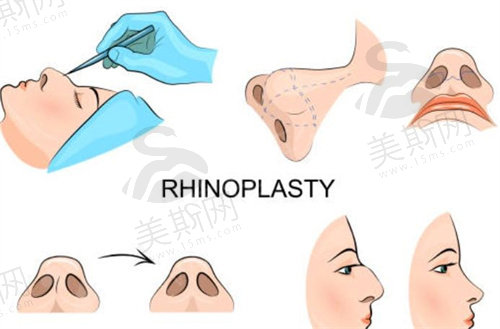长沙艺星整形医院做鼻子好吗