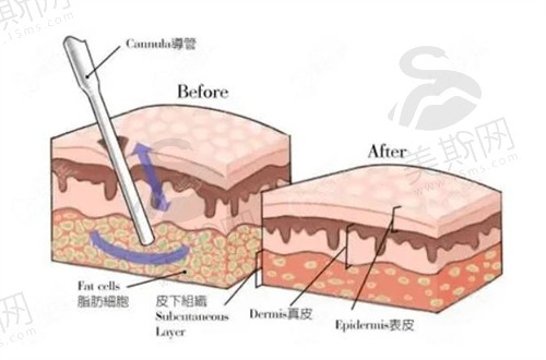 北京达美如艺医疗美容吸脂口碑很不错