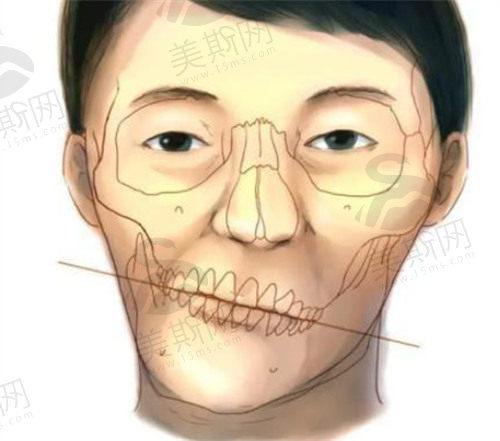 骨性地包天正颌手术后脸型会改变吗？