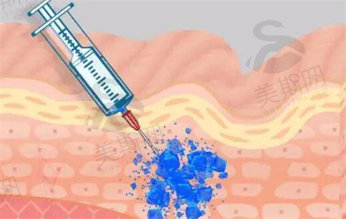 玻尿酸注射后注意事项