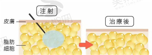 溶脂 针是什么