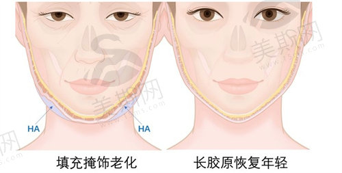 脸部馒化会自然消退吗