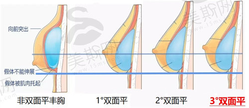 林沸腾隆胸是双平面技术吗