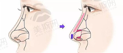 adm鼻基底填充会移位吗