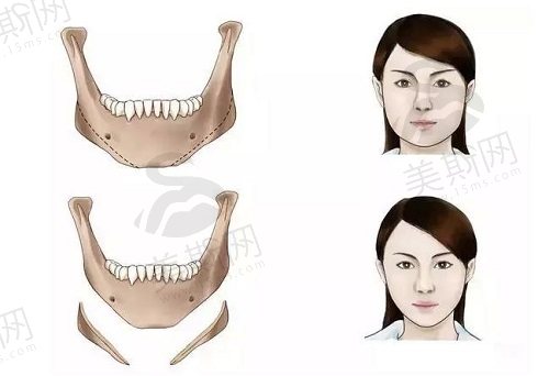 罗延平改脸型术中感受