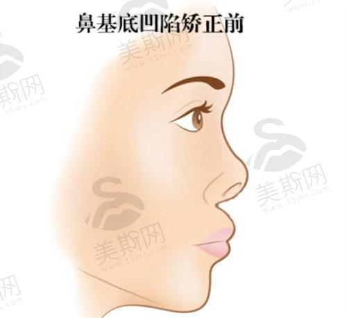 鼻基底凹陷矫正前