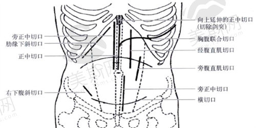 腹壁整形的几种切口类型
