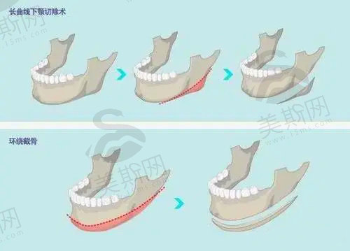 赵贵庆医生做磨骨手术好不好