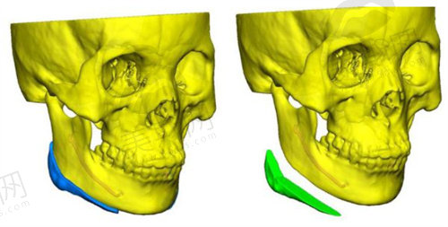 3D打印人工骨修复下颌角的技术优势明显