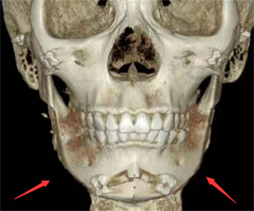 什么是3D打印人工骨修复技术？