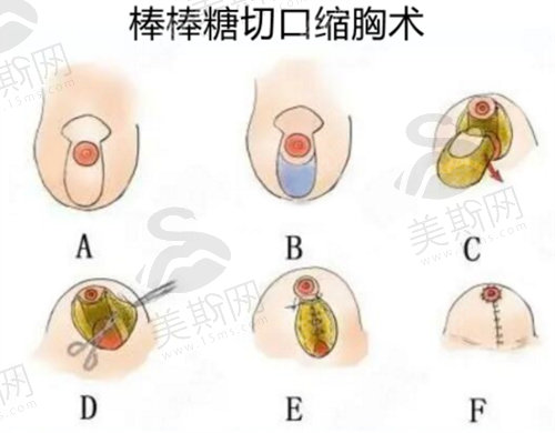 缩胸手术是怎么做的？