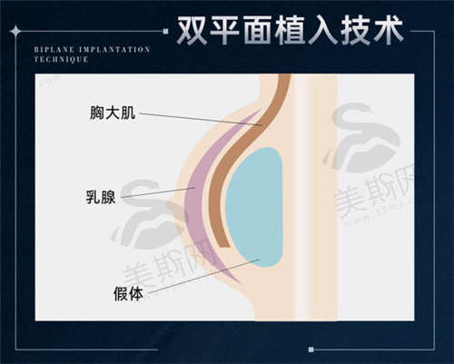 陈育哲医生做曼托假体隆胸贵不贵