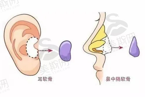 耳软骨隆鼻