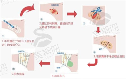 腋臭手术怎么做的