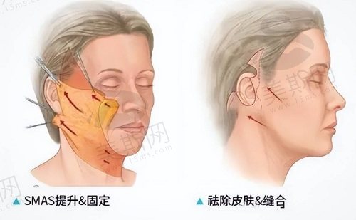 筋膜悬吊术手术过程是怎样做的