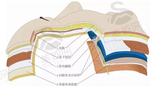 筋膜悬吊除皱术能维持多久