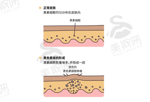 黑色胎记长毛