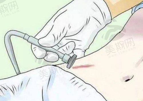 黑色烫伤疤痕怎么去除