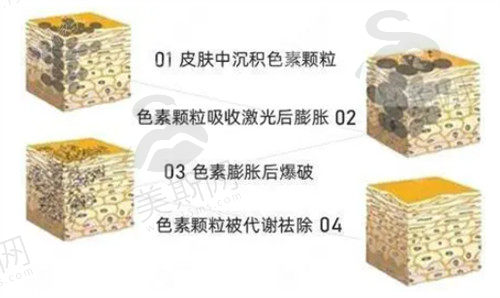 菲蜜丽激光紧缩术可以解决私处松弛、干涩、发黑等问题，成效明显