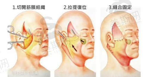 脸部皮肤松弛做什么整形好