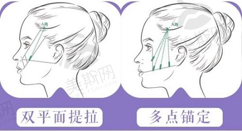 脸部皮肤松弛做什么整形好