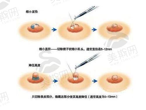 成都做乳头内陷矫正的医院排名