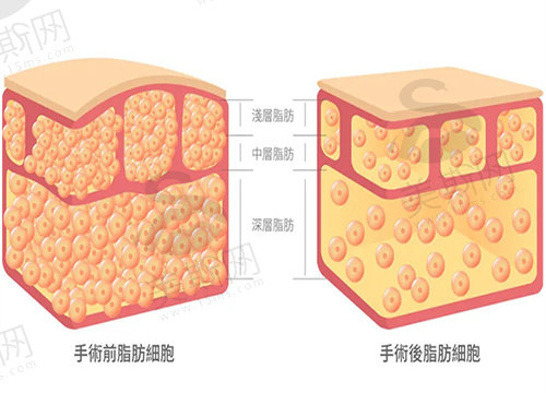 德国水动力环吸多久能恢复