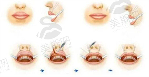 厚唇改薄手术是怎么做的？