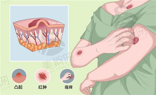 疤痕疙瘩怎么治疗可以消除不 复发？