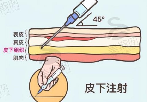 北京注射艾维岚童颜针的医院