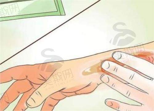 疤痕形成后多长时间祛疤好