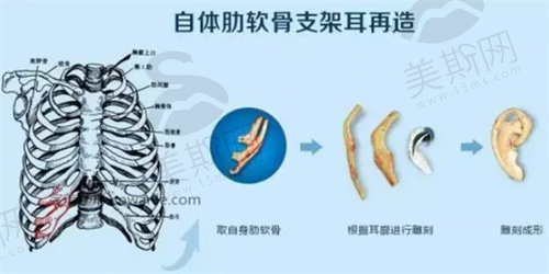 耳再造手术能和正常人的耳朵一样吗？